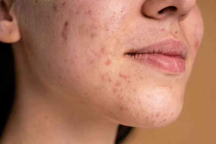 Chocolate causa espinhas e acnes?